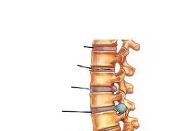 Osteokondrosiaren garapenaren lau fase